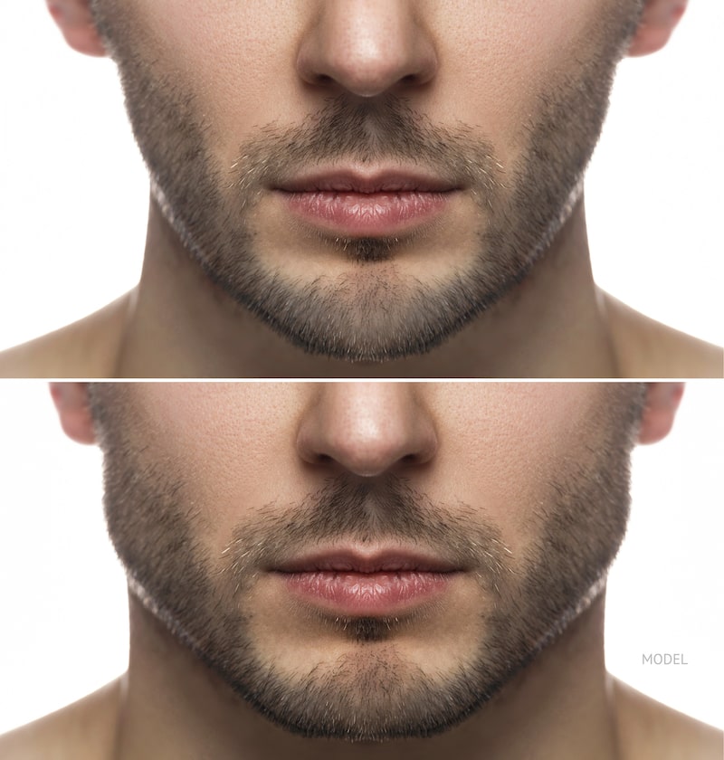 Man Before And After A Jaw Implant 